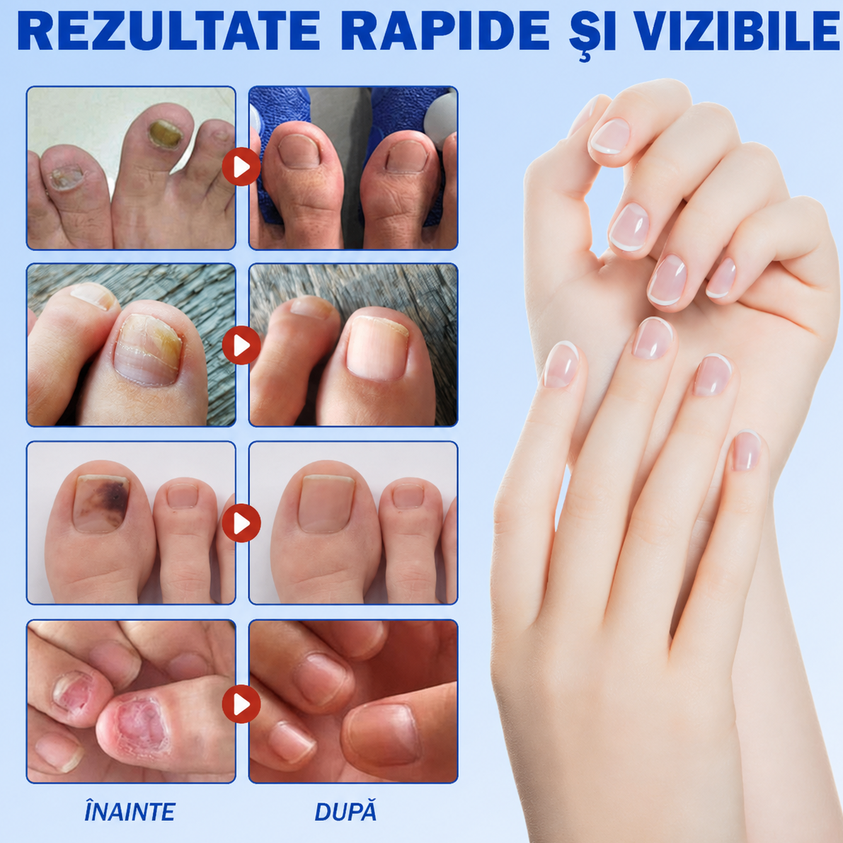 Fungal Nail Patches